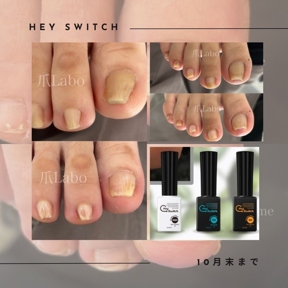 期限間近！ジェルネイルで巻き爪ケア【爪Labo】ヘイスイッチ | 爪Labo