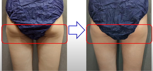 マッコイ | ノンFシェイプEX G 詰め替え用