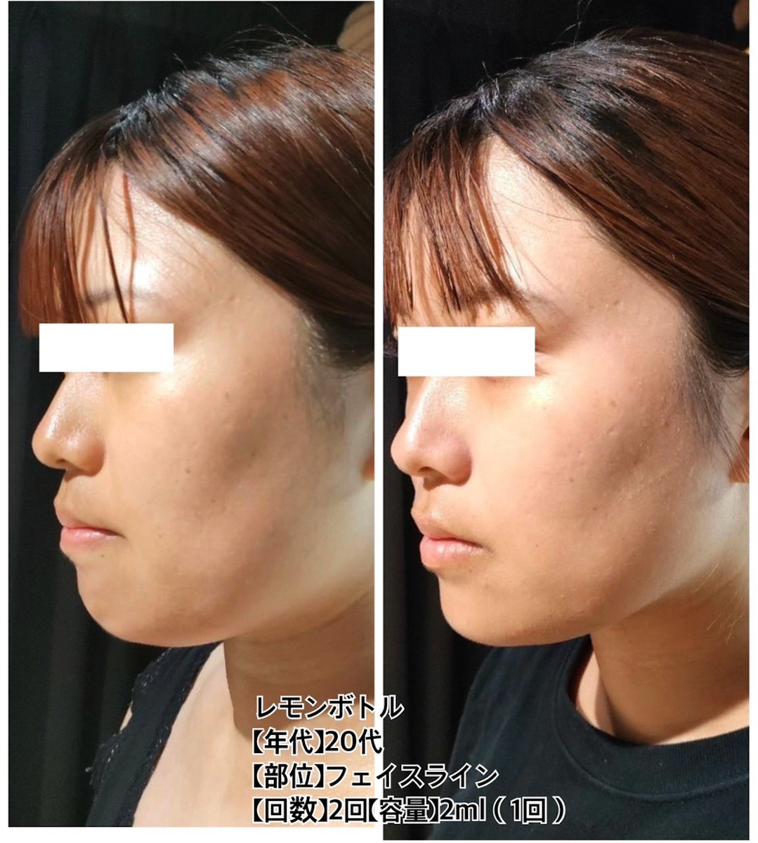 レモンボトル - エステティックサロンSARA | 山口県宇部市