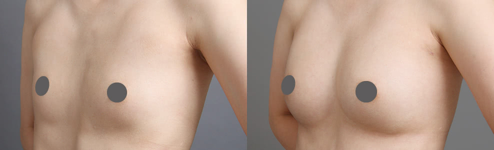 脂肪豊胸で漏斗胸による凹みを改善した症例写真（29歳/女性）