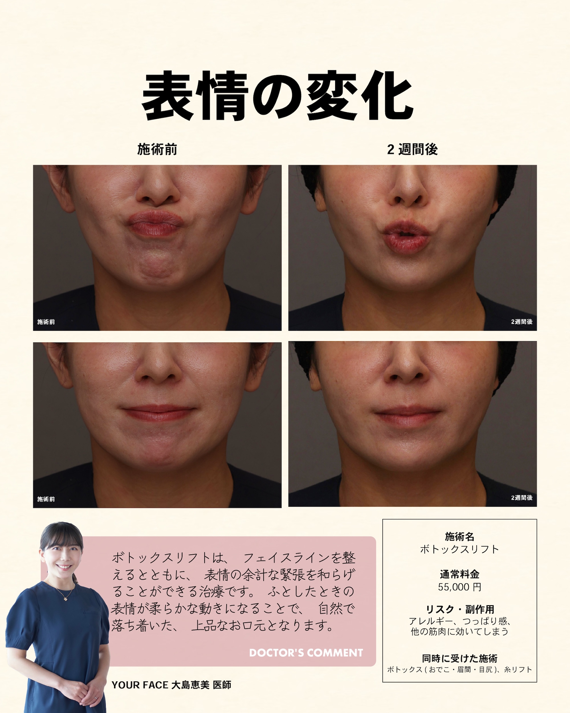 ボトックス – YOUR FACE