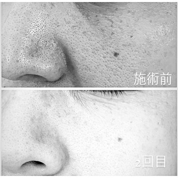 剥離あり」ハーブピーリング 2回目 | Genie（ジーニー）