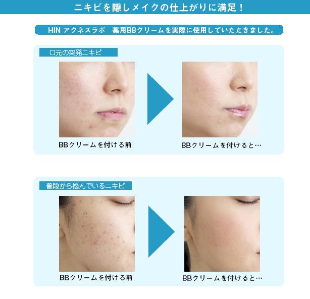 HINアクネスラボ 薬用BBクリーム(ライトベージュ)【医薬部外品】