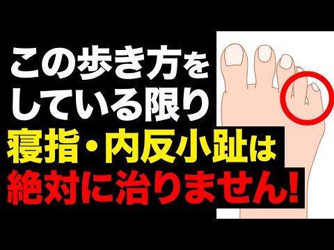 Warning ⚠️] People with flat pinky toes and hallux varus walk