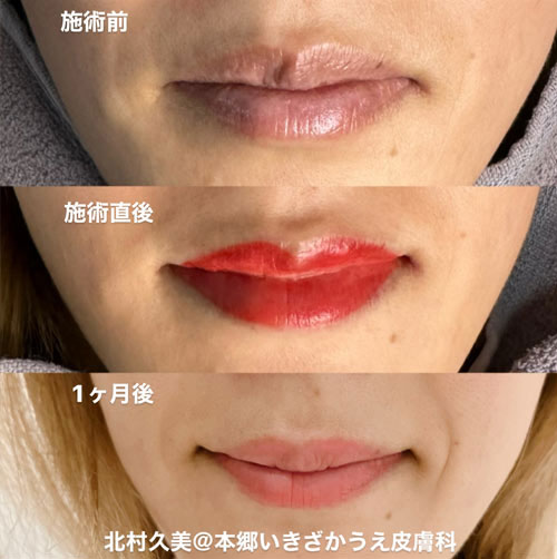 アートメイク｜本郷いきざかうえ皮膚科｜文京区