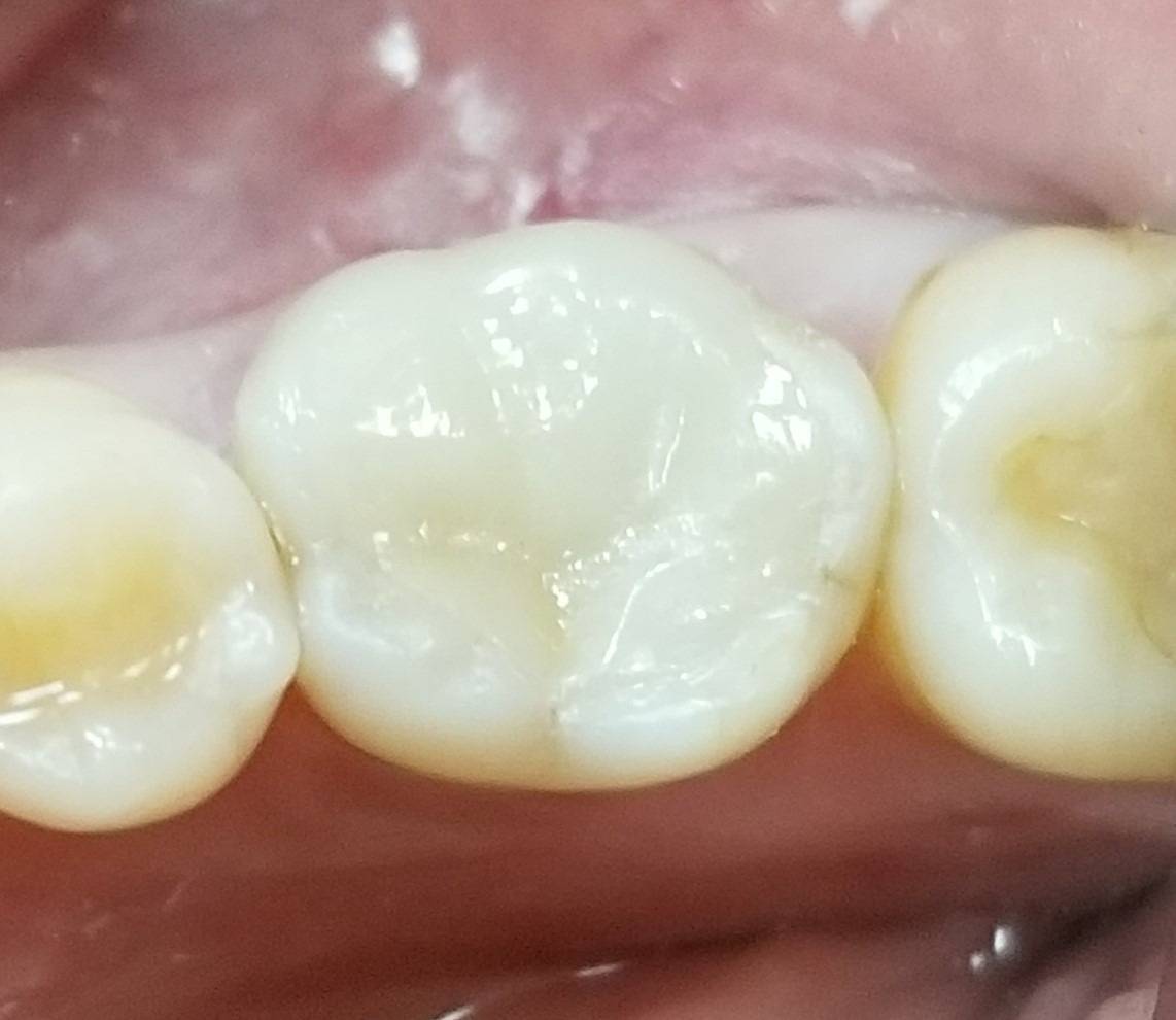 銀歯から白いセラミックへ。見た目が変わり笑えるようになりました
