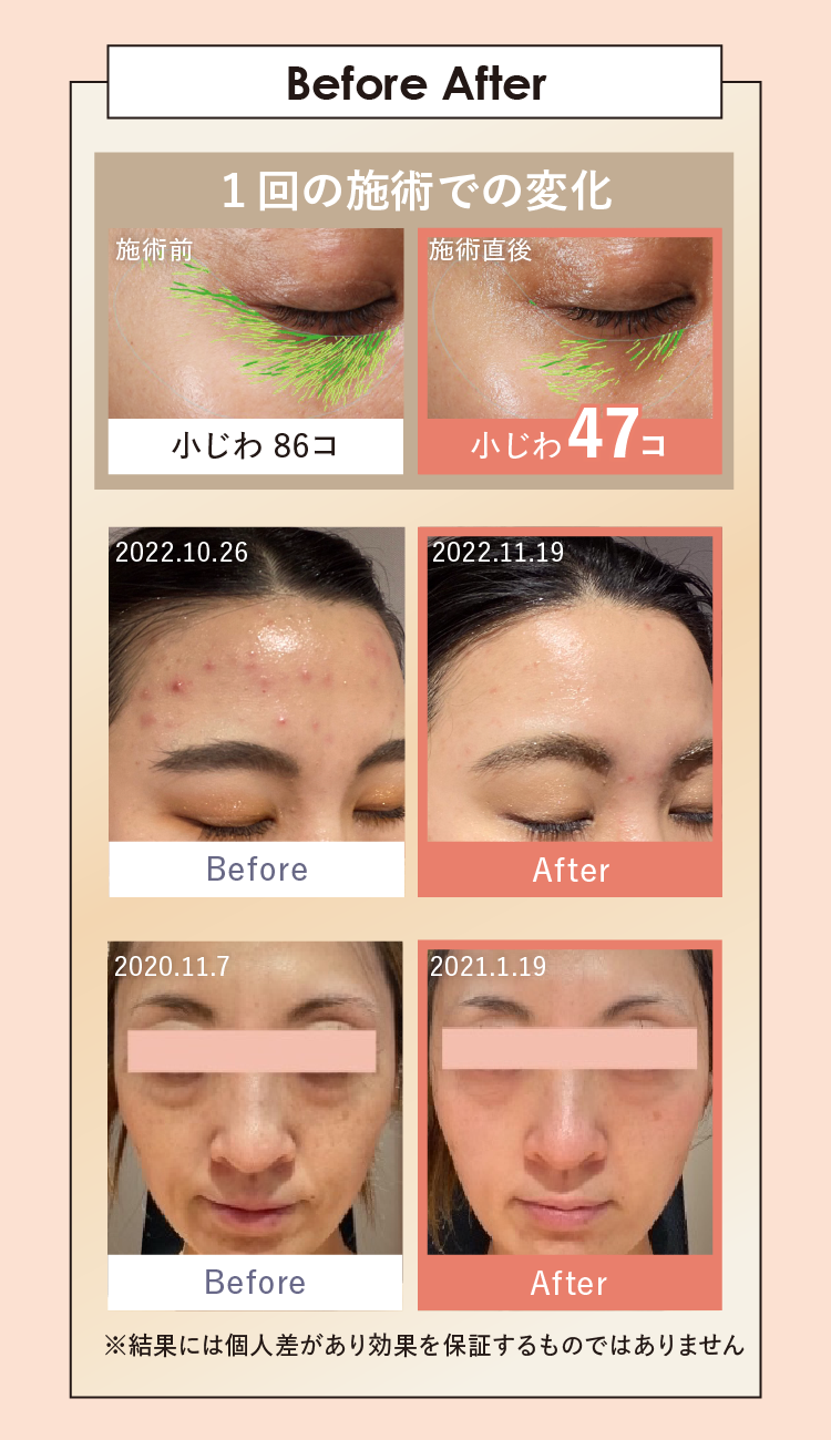 ボディアーキ ベビースキン プラン」開始 | 【公式】定額制セルフ