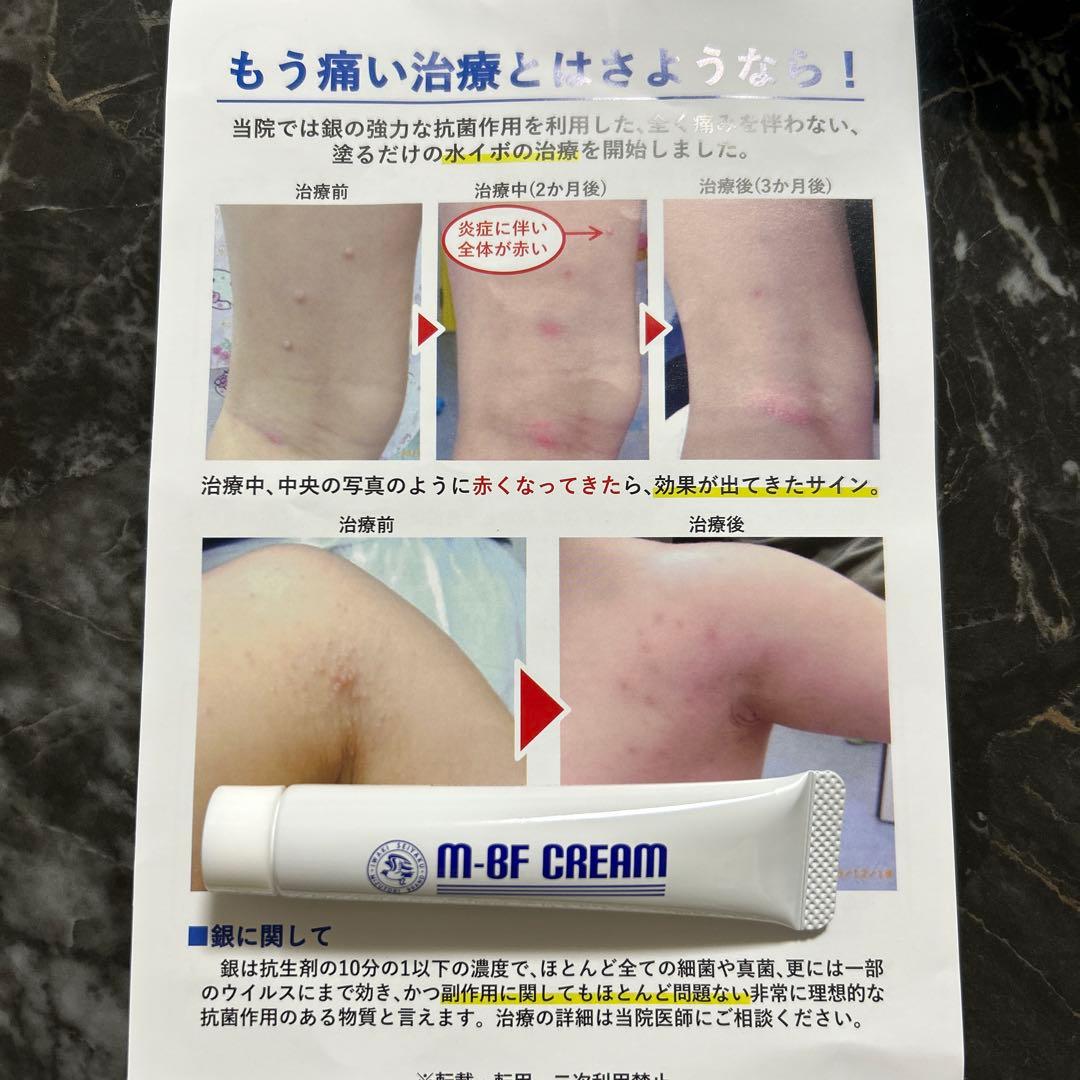 痛くない水イボ治療を行っています。（M -BFクリーム） | 第二服部医院