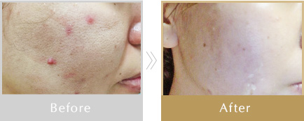 リベルハーブピーリング | トータルビューティーサロン「ヴィアージュ